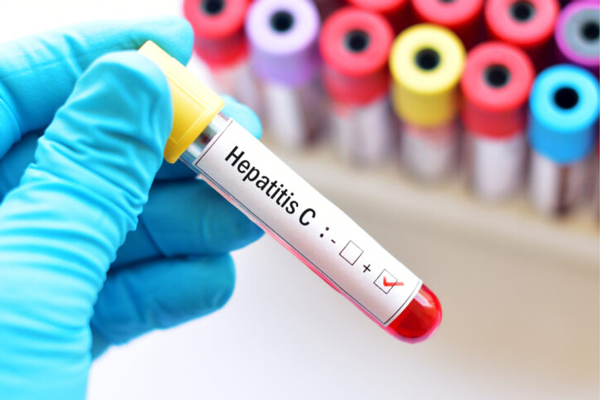 Hepatitis