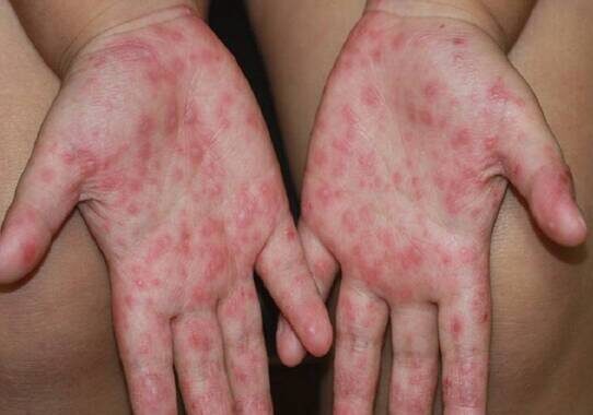 El virus Coxsackie se presenta por medio de la fiebre, malestar del cuerpo y erupciones o ampollas en manos, pies y boca.