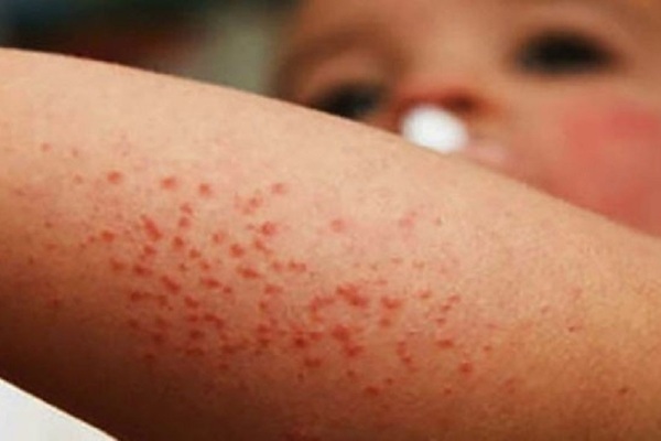 Alertan sobre aumento de brotes de sarampión en fronteras de EE.UU. con México y Canadá