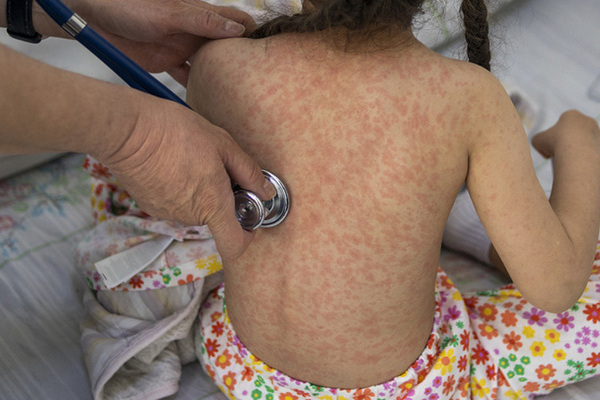 En México, el sarampión ya cobró la vida de 9 personas, la cifra se duplicó debido a que en la última semana Chihuahua pasó de 4 a 8 decesos