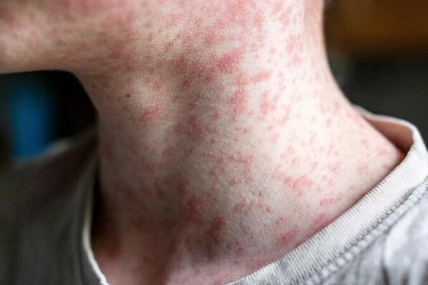 México ocupa el segundo lugar en número de casos confirmados de sarampión en la Región de las Américas, después de Canadá y encima de EE.UU