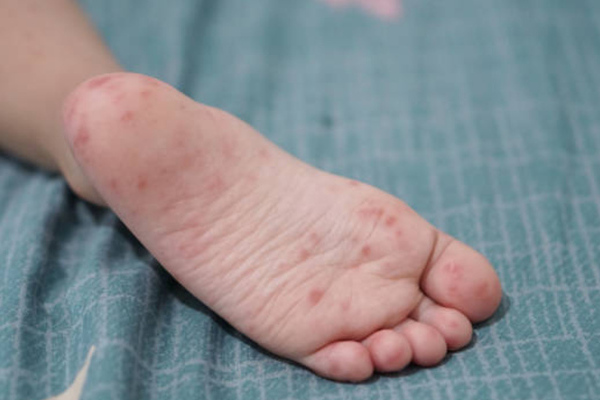 Tras un reporte, personal jurisdiccional acudió al deportivo Club Alpha y se identificaron 11 casos probables en menores de edad de coxsackie