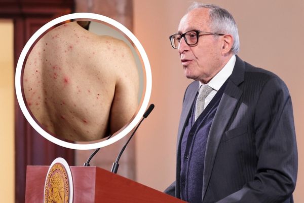 David Kershenobich, titular de la Secretaría de Salud, confirmó 4 mil 353 casos de sarampión en el país y 17 fallecimientos