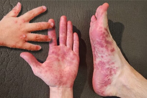 Hay brotes de virus de Coxsackie en 73 escuelas públicas y cuatro privadas de Puebla