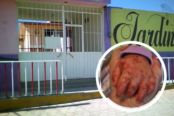Rigoberto Zamudio informó que el mayor número de contagios se concentra en Chiautempan, son cuatro casos de Coxsackie en un preescolar
