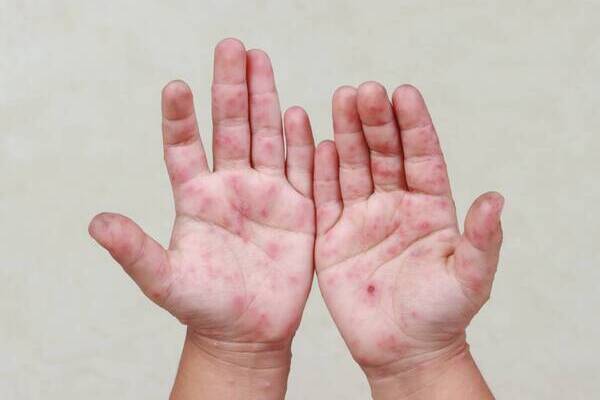 Ante el brote de Coxsackie en 17 alumnos del Centro Escolar “Lázaro Cárdenas”, en Izúcar, el personal realizó labores de desinfección