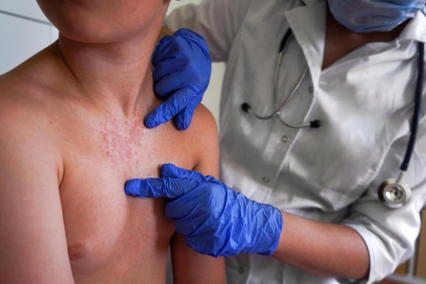 Cancelan actos masivos por casos de sarampión en Chiapas