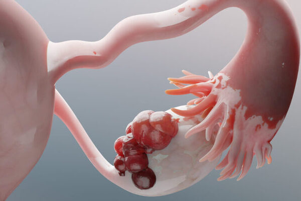 Descubrieron una combinación de terapias que ofrece esperanzas a pacientes con cáncer de ovario que no responden a tratamientos existentes