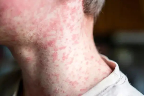 La transmisión del virus de sarampión se concentra de manera abrumadora en Chihuahua, que acumula cuatro mil 459 casos confirmados