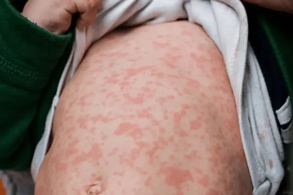 La Secretaría de Salud llamó a la población a reforzar las medidas de prevención, en especial la vacunación contra sarampión en Puebla