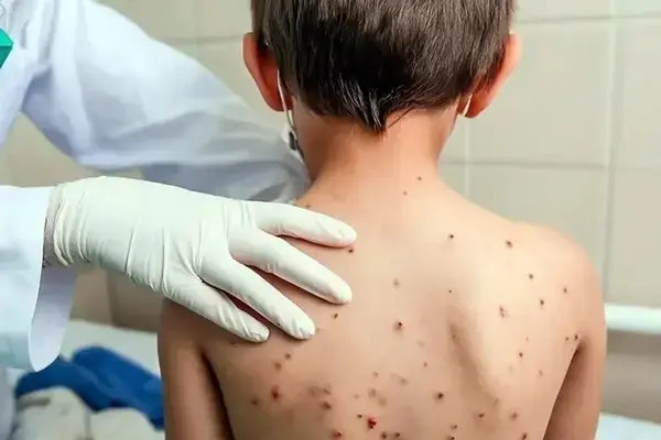 De acuerdo con el reporte médico, el segundo caso de sarampión se trata de un niño de 8 años de edad, originario de la ciudad de Puebla