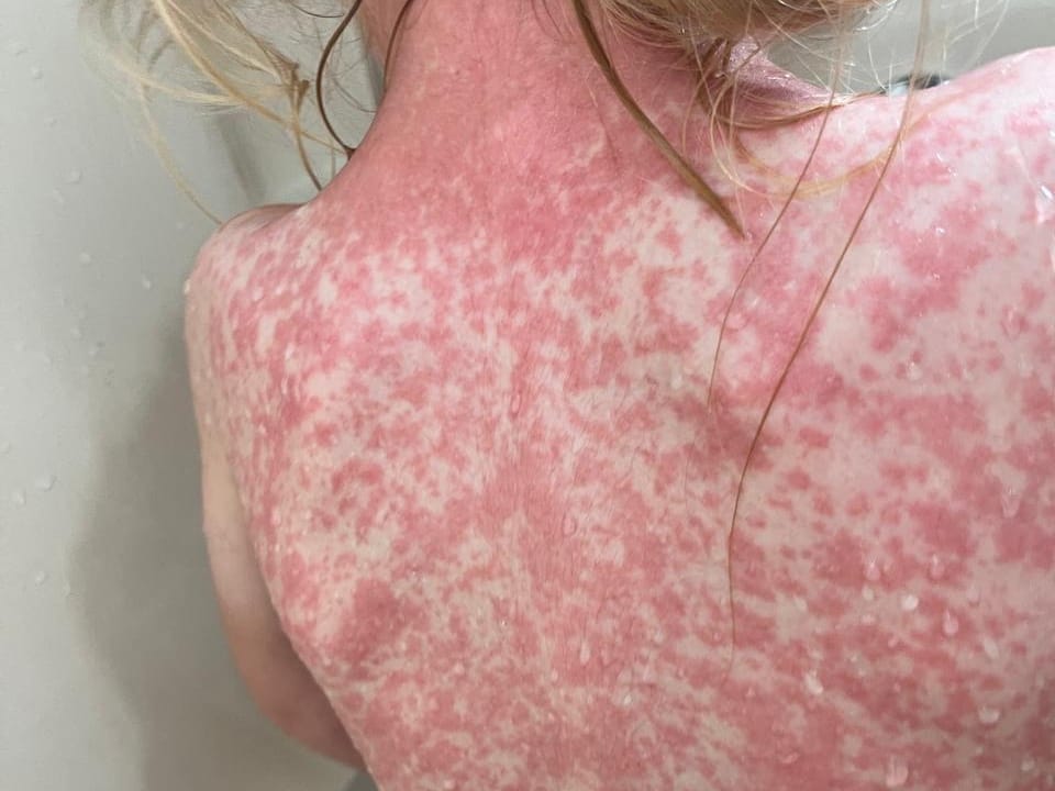 Región Puebla-Tlaxcala acumula cuatro casos confirmados de sarampión y 7 probables