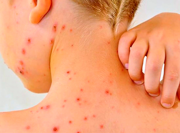 Sarampión: Región Puebla-Tlaxcala acumula 14 casos confirmados y 111 probables, según Secretaría de Salud Federal