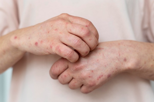 El secretario de Salud informó que en Tlaxcala se tienen dos casos positivos de sarampión después de que se reclasificara un tercer caso