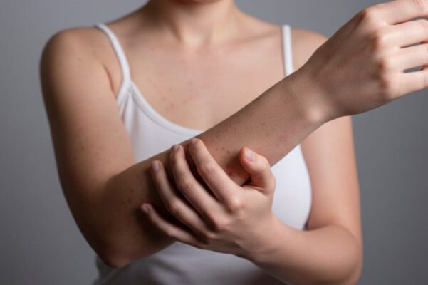 Puebla reporta 16 casos positivos de sarampión y 58 en proceso de diagnóstico: Secretaría de Salud