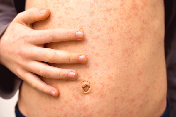 Se registra primer casi de Sarampión en Tlaxcala; SESA abre macrocentros de vacunación en 4 municipios