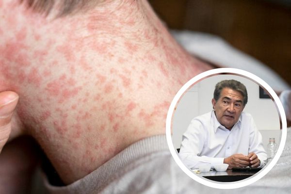 Joaquín Espidio descartó una suspensión de clases por el aumento de contagios de sarampión, pues en cada caso se aplica cerco sanitario