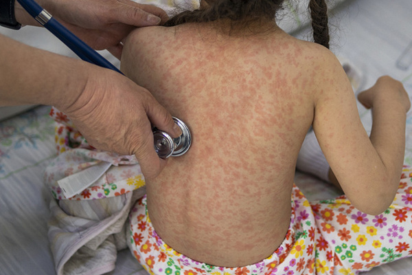 La OPS insistió en que es necesaria una “acción inmediata y coordinada” por parte de todos los países para que el sarampión pueda controlarse