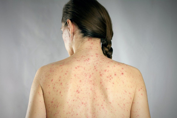 México acumula 29 muertes por sarampión en siete estados, desde el inicio del brote detectado en 2025, el cual se mantiene activo este año